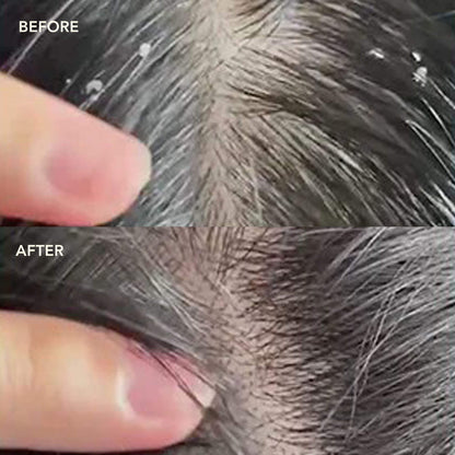 NEEM + SALICYLIC ACID Exfoliating Scalp Serum