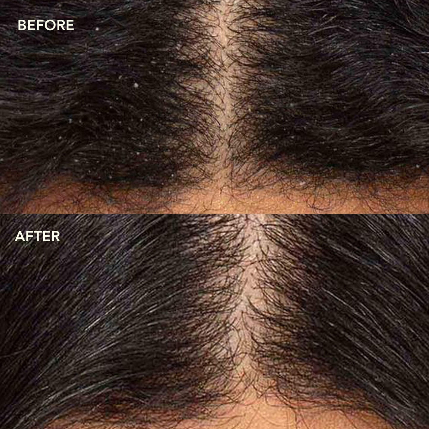 NEEM + SALICYLIC ACID Exfoliating Scalp Serum